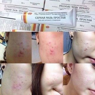 Kem mỡ trị mụn Sulfuric của Nga