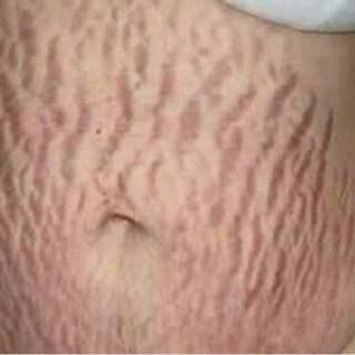trị thâm dạn linh hương