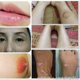 trị thâm dạn linh hương