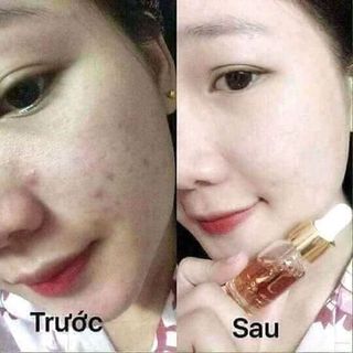 Serum Thảo Dược Hoàng Cung Kiều Beauty Queen