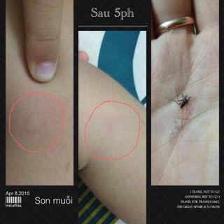 SON TRỊ CÔN TRÙNG ĐỐT