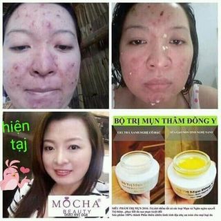 KEM ĐẶC TRỊ MỤN VÀ THÂM MOCHA