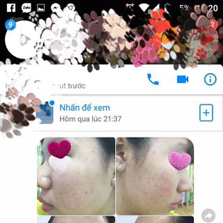 Đông y trị mụnnám tàn nhang