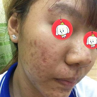 Đông y trị mụnnám tàn nhang