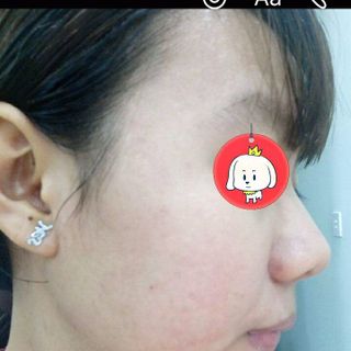 Đông y trị mụnnám tàn nhang