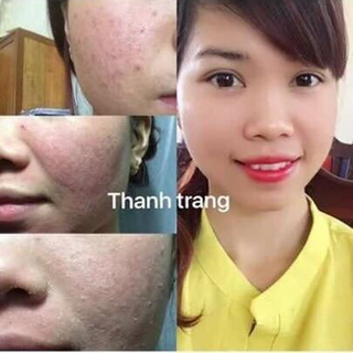 Dung dịch trị mụn thanh trang