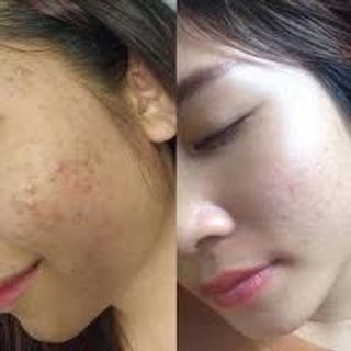 Thanh mộc hương đặc trị mụn mẫu đơn