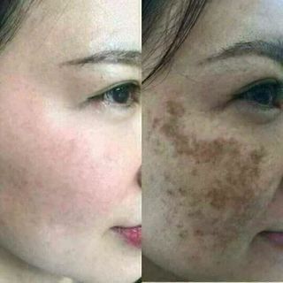 trị nám tàn nhang