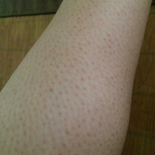 Mọi người ơi ai bị tình trạng như hình nhiều năm k khỏi thì ib e nhé e bán thuốc chữa được bệnh này bản thân e đã từng bị 2 cánh tay và 2 bên đùi jo e đã khỏi rồi ạ mấy năm rồi không tái lại khỏi hẳn luôn đấy nên ai muốn hết mấy cái mụn đáng gét này thì ib e tư vấn nhé