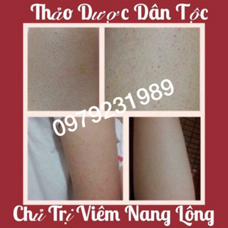 thuốc chuyên trị viêm nang lông