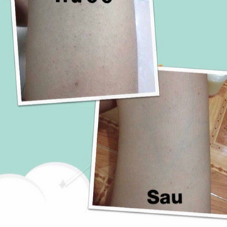thuốc chuyên trị viêm nang lông