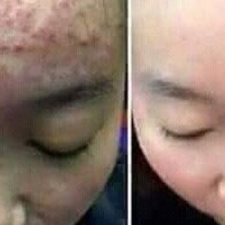 kem trị mụn Lavoine