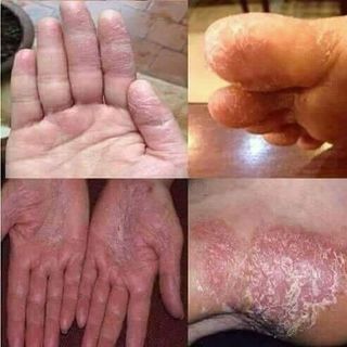 kem đông y đặc trị á sừng nấm các loại trên da