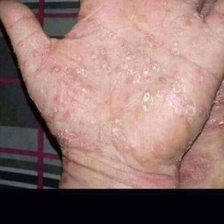 kem đông y đặc trị á sừng nấm các loại trên da