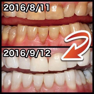 Gel tẩy trắng răng Nhật Bản