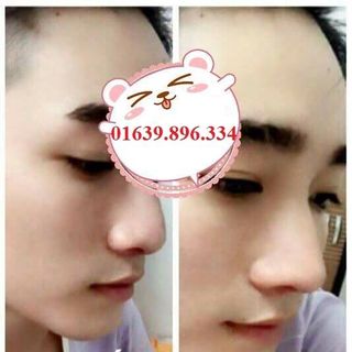 Sụn Nâng Mũi Hàn Quốc