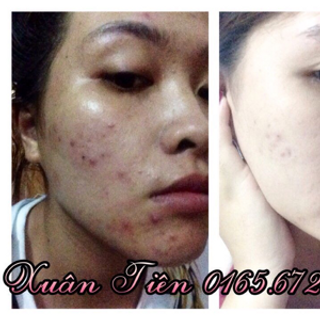 THUỐC TRỊ MỤN MY MIU