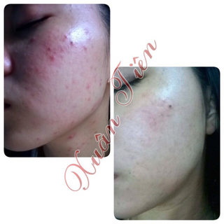 THUỐC TRỊ MỤN MY MIU