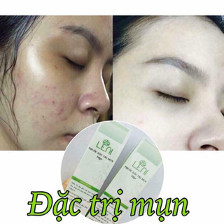Leni thuốc đặc trị mụn