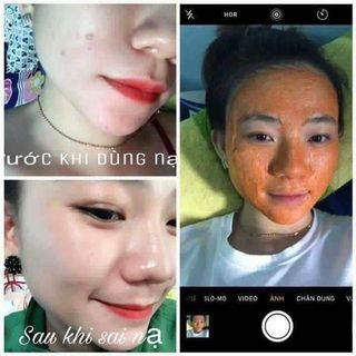 NẠ BẮC THẢO DƯỢC