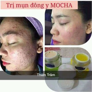 BỘ TRỊ MỤN ĐÔNG Y MOCHA