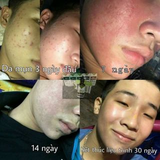 Ô Liên Rô - Đặc Trị Mụn Rỗ Nám