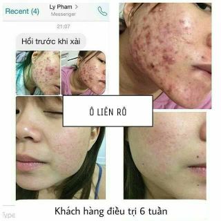 Ô Liên Rô - Đặc Trị Mụn Rỗ Nám