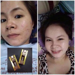 Kem Trị Mụn Độc Quyền My Miu