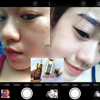 Kem Trị Mụn Độc Quyền My Miu