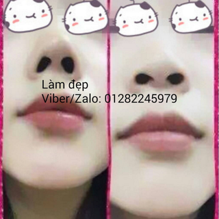 Sụn Nâng mũi NOT