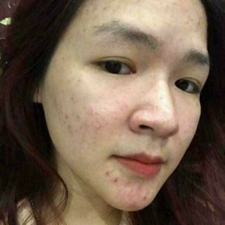 TRỊ MỤN LINH HƯƠNG