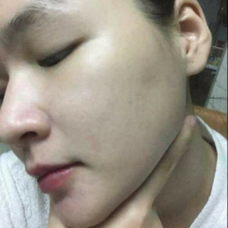 TRỊ MỤN LINH HƯƠNG