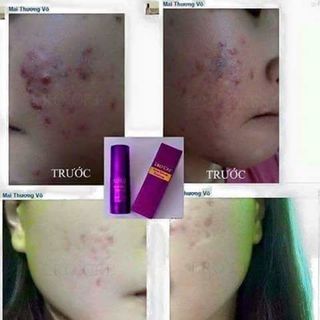 TRỊ MỤN LROCRE - SẠCH MỤN SÁNG DA CAM KẾT HIỆU QUẢ