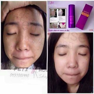 TRỊ MỤN LROCRE - SẠCH MỤN SÁNG DA CAM KẾT HIỆU QUẢ