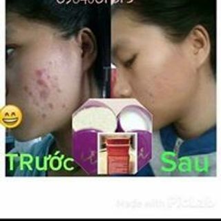 NẠ Ủ - TRẮNG DA KHÁNG KHUẨN TRỊ DỊ ỨNG TRỊ MỤN CÁMSE CHÂN LÔNG