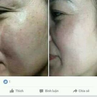 serum đặc trị nám tàn nhang đồi mồi
