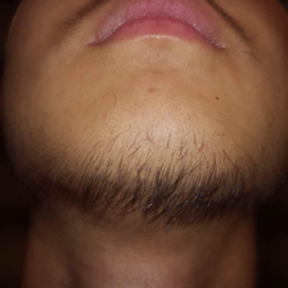 Thuốc mọc râu tóc trị hói Minoxidil Foam hàng Mỹ về