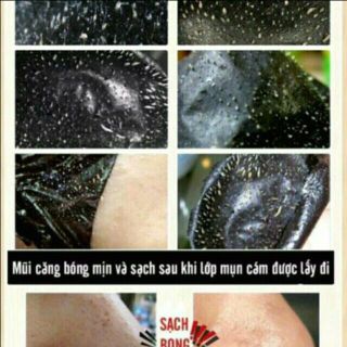 gel lột mụn than tre