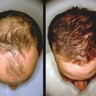 thuốc mọc tóc-râu-chân mày Rogaine minoxidil 5