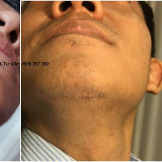 thuốc mọc tóc-râu-chân mày Rogaine minoxidil 5