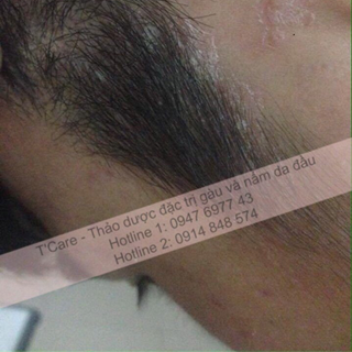 DẦU GỘI TRỊ GÀU VÀ NẤM TCARE