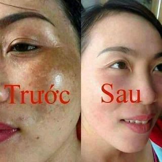 KEM ĐẶC TRỊ NÁM MOCHA