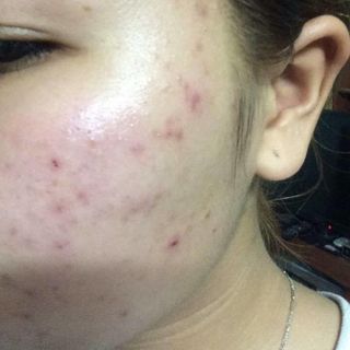 bột thuốc bắc trị mụn