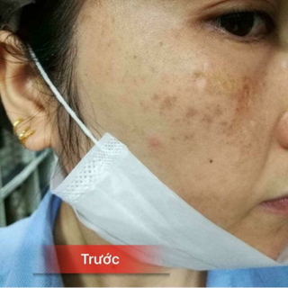 KEM ĐẶC TRỊ NÁM VÀ TÀN NHANG