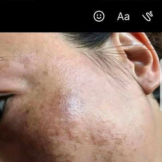 Trị mụn - Tiên Tiên Dược