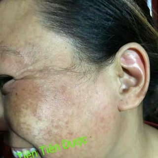 Trị mụn - Tiên Tiên Dược