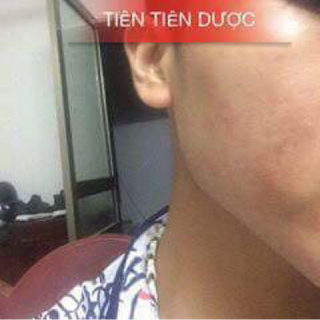 Trị mụn - Tiên Tiên Dược