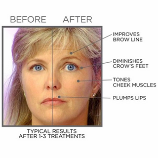 Serum nâng cơ xóa nếp nhăn chống lão hóa CARLMARK BTX