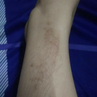 Tinh Dầu Trị Thâm Gia Truyền