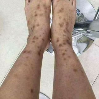 trị thâm gia truyền